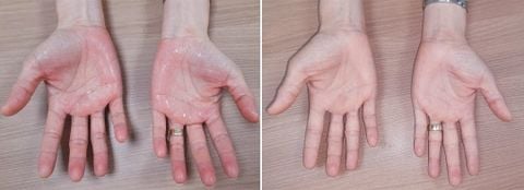 TOP 6 LOẠI THUỐC CHỮA MỒ HÔI TAY HIỆU QUẢ