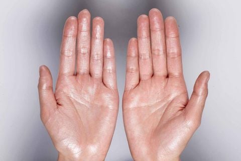 CÁCH TRỊ MỒ HÔI TAY CHÂN TẠI NHÀ HIỆU QUẢ ĐẾN 90%