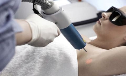 TIA LASER CÓ TRỊ DỨT ĐIỂM MỒ HÔI NÁCH KHÔNG?