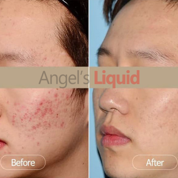 Tinh Chất Mờ Nám Chuyên Sâu Angel's Liquid Tranexamic Mela Ampoule – Lam  Thảo Cosmetics