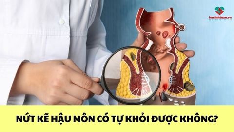 Nứt kẽ hậu môn có tự khỏi được không? Bao lâu thì lành?