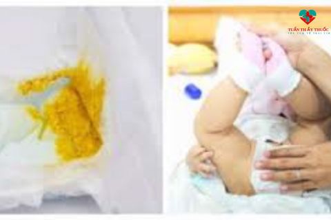 Trẻ sơ sinh đi ngoài có hạt vàng nguyên nhân dấu hiệu và giải pháp
