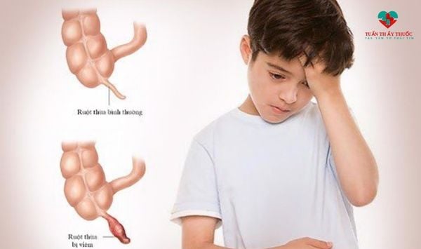 Biểu hiện của đau bụng đi ngoài kèm sốt ở trẻ là như thế nào