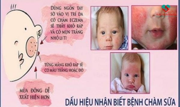 Những dấu hiệu nào cho thấy bé sơ sinh bị chàm sữa