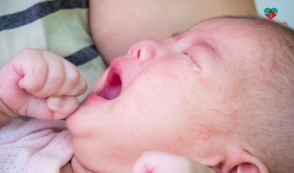 Trẻ tiêu chảy nhiều lần trong ngày do dị ứng sữa mẹ