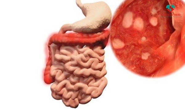 Bệnh Crohn khiến trẻ đau bụng sau khi ăn