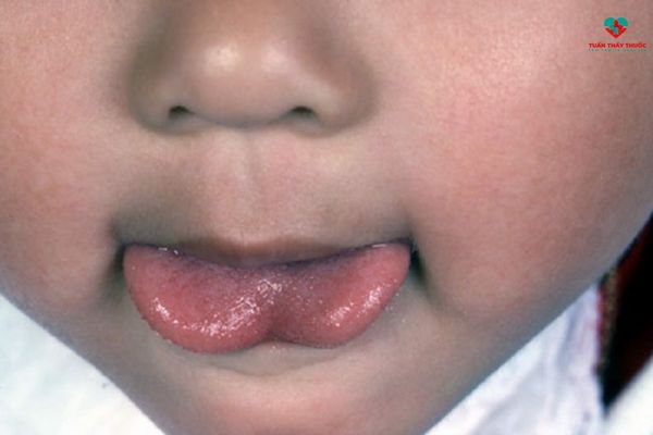 dính thắng lưỡi ở trẻ có triệu chứng như thế nào