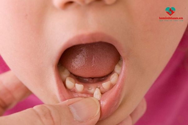 Bổ sung canxi cho trẻ thay răng như thế nào hiệu quả