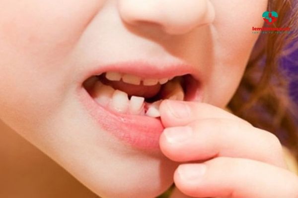 Tại sao cần bổ sung canxi cho trẻ thay răng