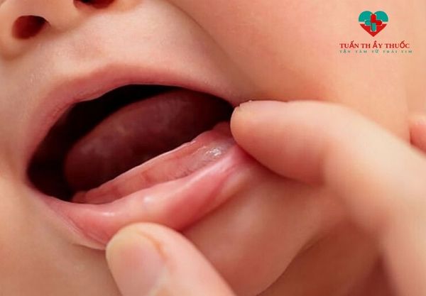 Trẻ thiếu canxi sẽ chậm mọc răng