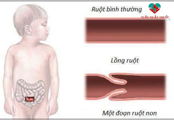 Trẻ đi ngoài có máu nhầy do bị lồng ruột cấp tính