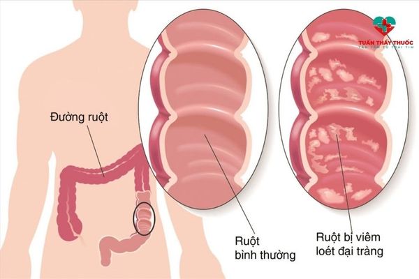 Thuốc bacillus subtilis giúp bé thoát khỏi loạn khuẩn đường ruột như thế nào?