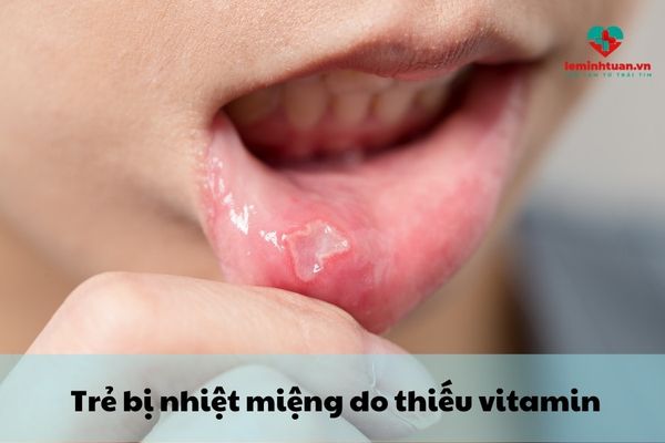 Trẻ nhiệt miệng thiếu vitamin gì?