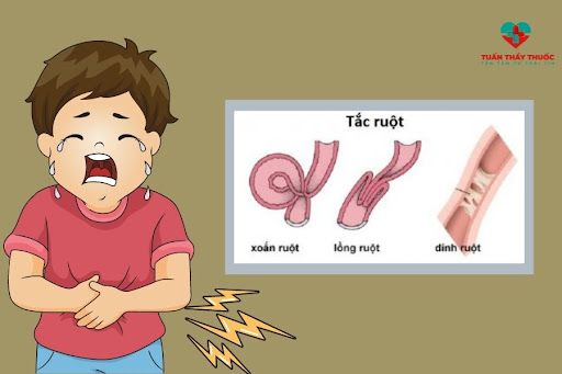 Dị tật đường tiêu hóa làm trẻ hay bị nôn