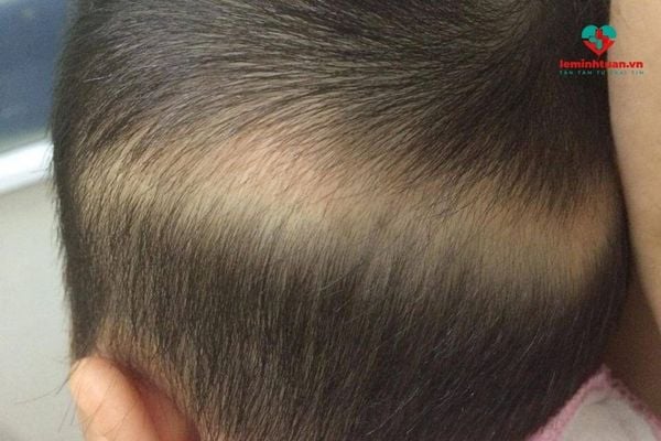Trẻ rụng tóc vành khăn điều trị như thế nào?