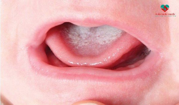 nấm lưỡi ở trẻ sơ sinh là thế nào?