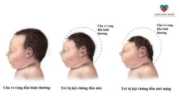 Chu vi vòng đầu trẻ sơ sinh như thế nào là bình thường