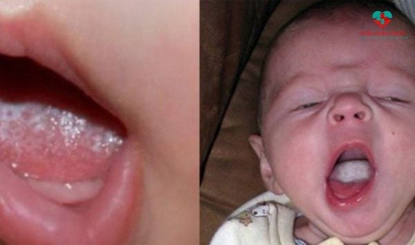 Phân biệt giữa nấm lưỡi ở trẻ sơ sinh và cặn sữa