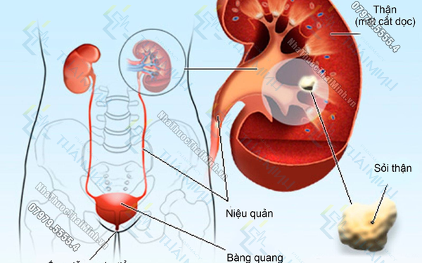 Sỏi thận là gì? Cặn thận có thể biến thành sỏi thận không?