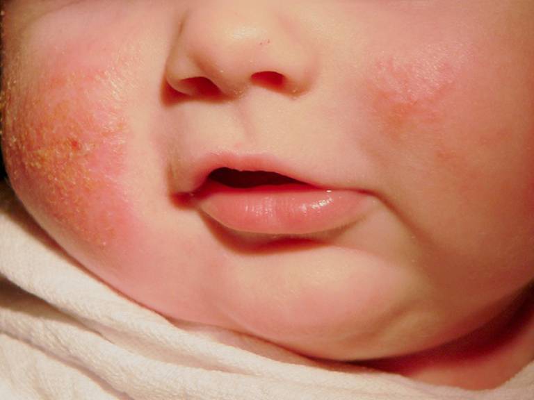Các cách hạn chế và phòng ngừa khởi phát chàm da của trẻ
