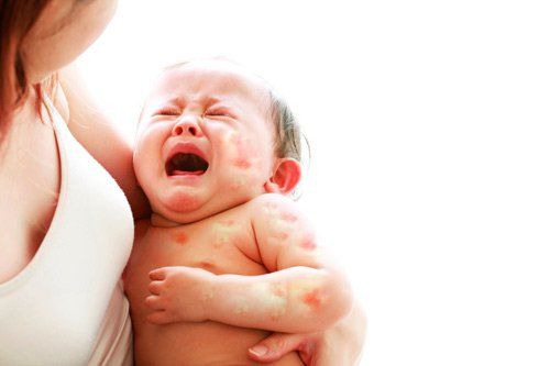 Trẻ vẫn có thể dị ứng đạm trong sữa mẹ