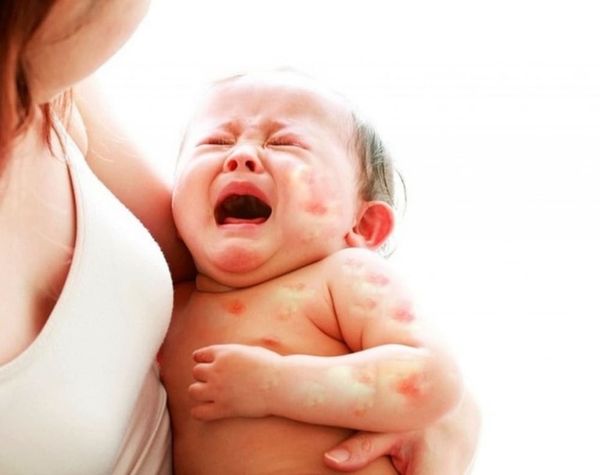 Tự nhiên phát dị ứng da