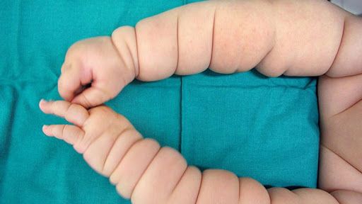 Tật vòng thắt bẩm sinh