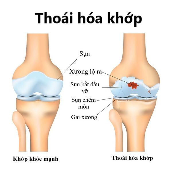 luu-y-chay-bo-khi-bi-thoai-hoa-khop-anh1