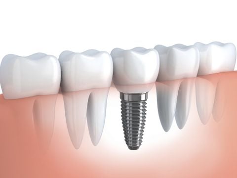 3 lý do không nên dùng chỉ nha khoa cho răng cấy ghép