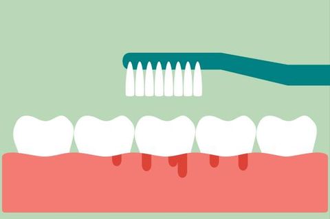 5 lý do tại sao nướu bị chảy máu và cách khắc phục