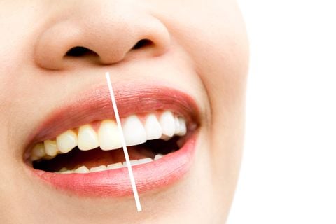 6 cách đơn giản tẩy trắng, làm trắng răng tự nhiên tại nhà