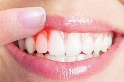 Các bệnh về răng do vệ sinh răng miệng kém thường gặp