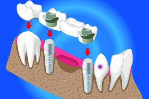 Trồng răng giả là gì? Có bao nhiêu phương pháp trồng răng giả?