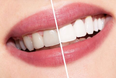 Tẩy trắng răng giá bao nhiêu? Phương pháp tẩy trắng răng hiệu quả tốt nhất
