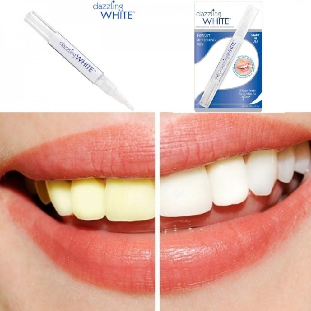 Tẩy trắng răng giá bao nhiêu và phương pháp tẩy trắng răng hiệu quả