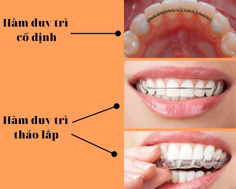 các loại niềng răng trong suốt