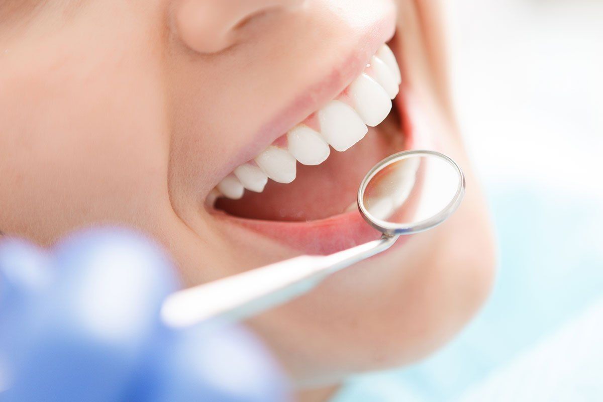 Tẩy trắng răng giá bao nhiêu và phương pháp tẩy trắng răng hiệu quả