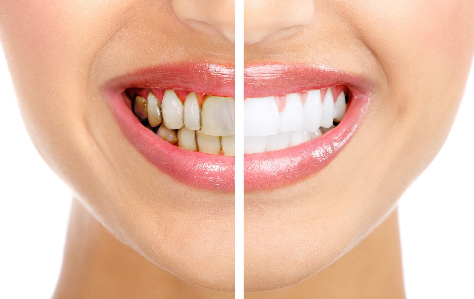 trước và sau khi niềng răng mắc cài sứ