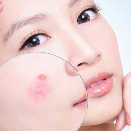 Kem trị mụn cần chứa Benzoyl Peroxide