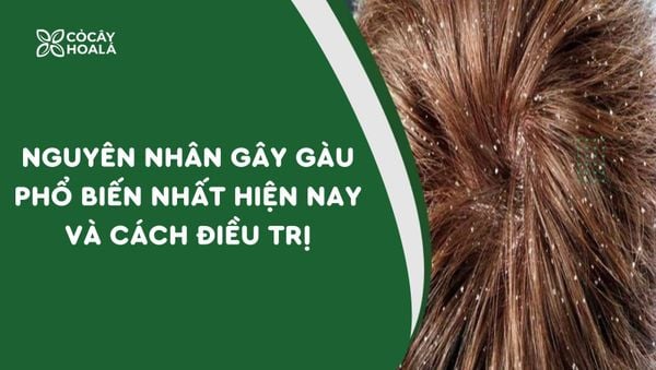 5 nguyên nhân gây gàu phổ biến nhất hiện nay và cách điều trị