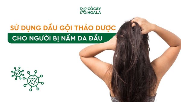 Người bị nấm da đầu có nên chuyển sang dầu gội thảo dược không?