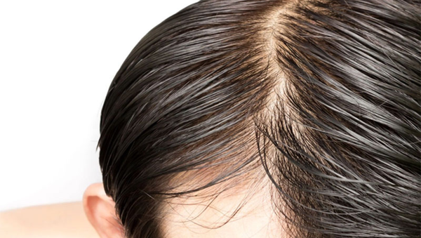 Nguyên nhân gây da đầu nhờn và rụng tóc