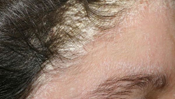 Viêm da tiết bã (Seborrheic Dermatitis)