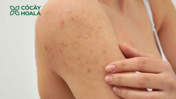 Da nhạy cảm là gì? Lý do nên sử dụng sữa dưỡng thể cho da