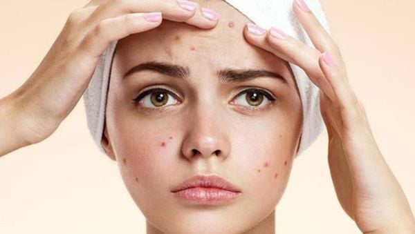 Nguyên nhân gây ra tình trạng mụn và đặc điểm của da mụn