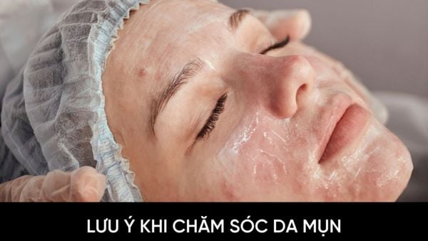Lưu ý khi chăm sóc làn da mụn