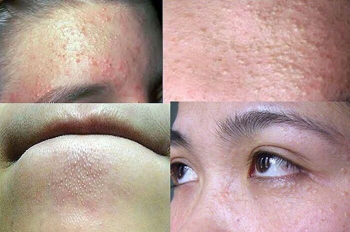Cách trị mụn ẩn dưới da đơn giản mà hiệu quả không ngờ