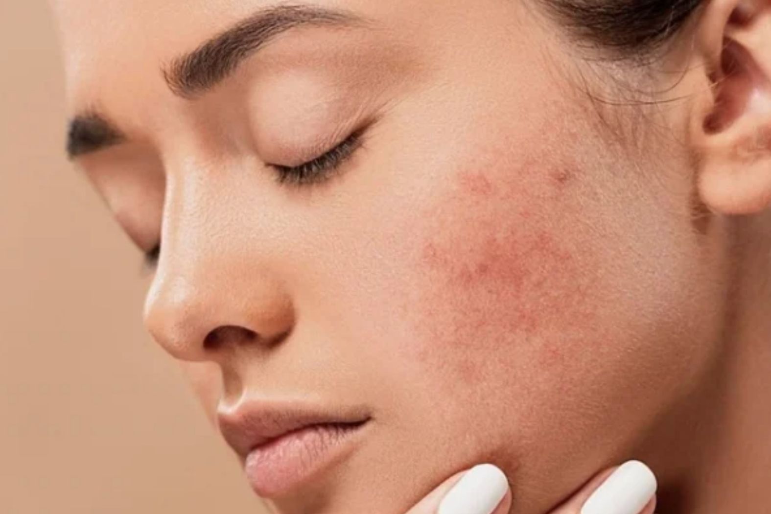 Hướng dẫn cách chăm sóc da mụn đúng cách