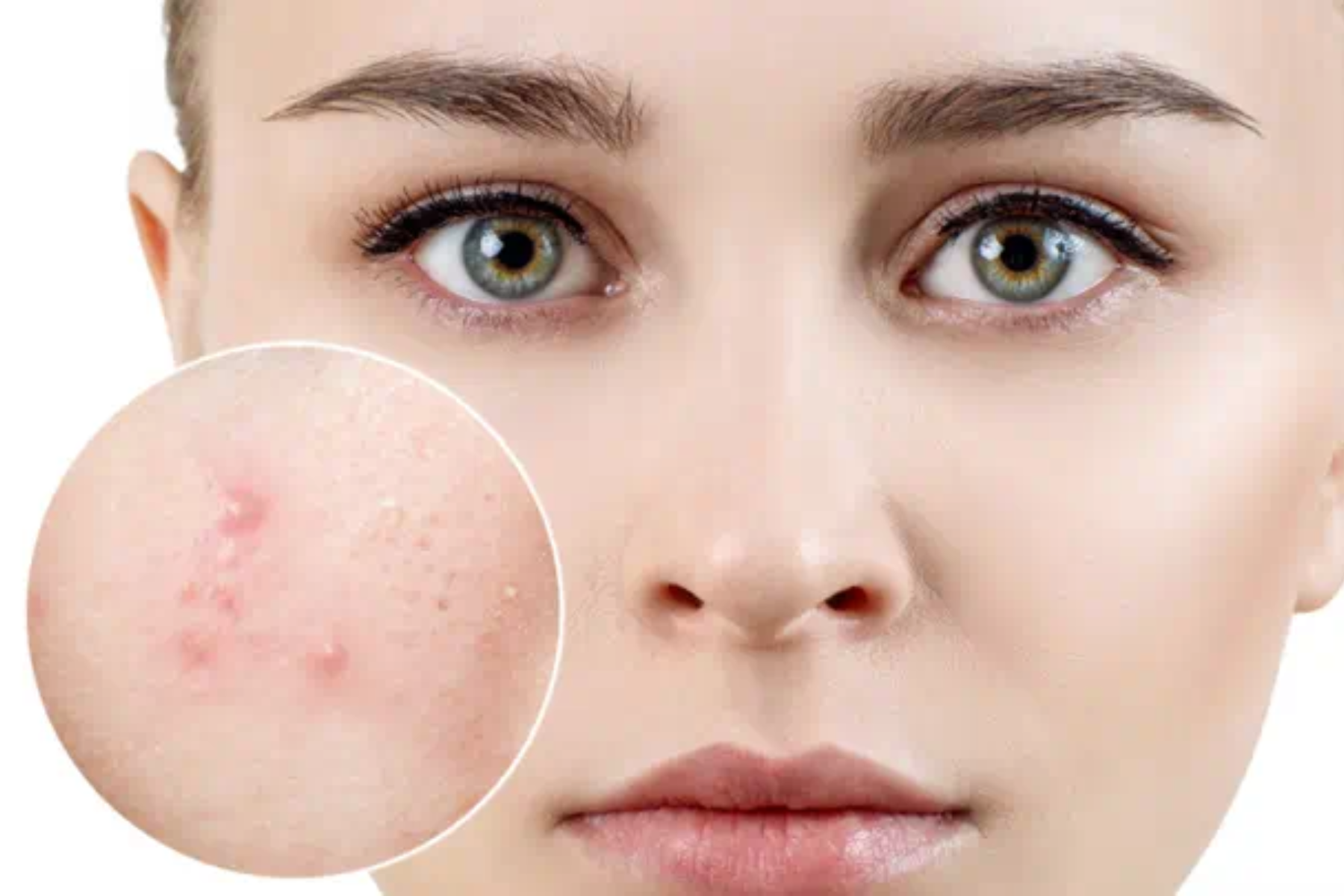 Mụn viêm và giải pháp khắc phục cho làn da