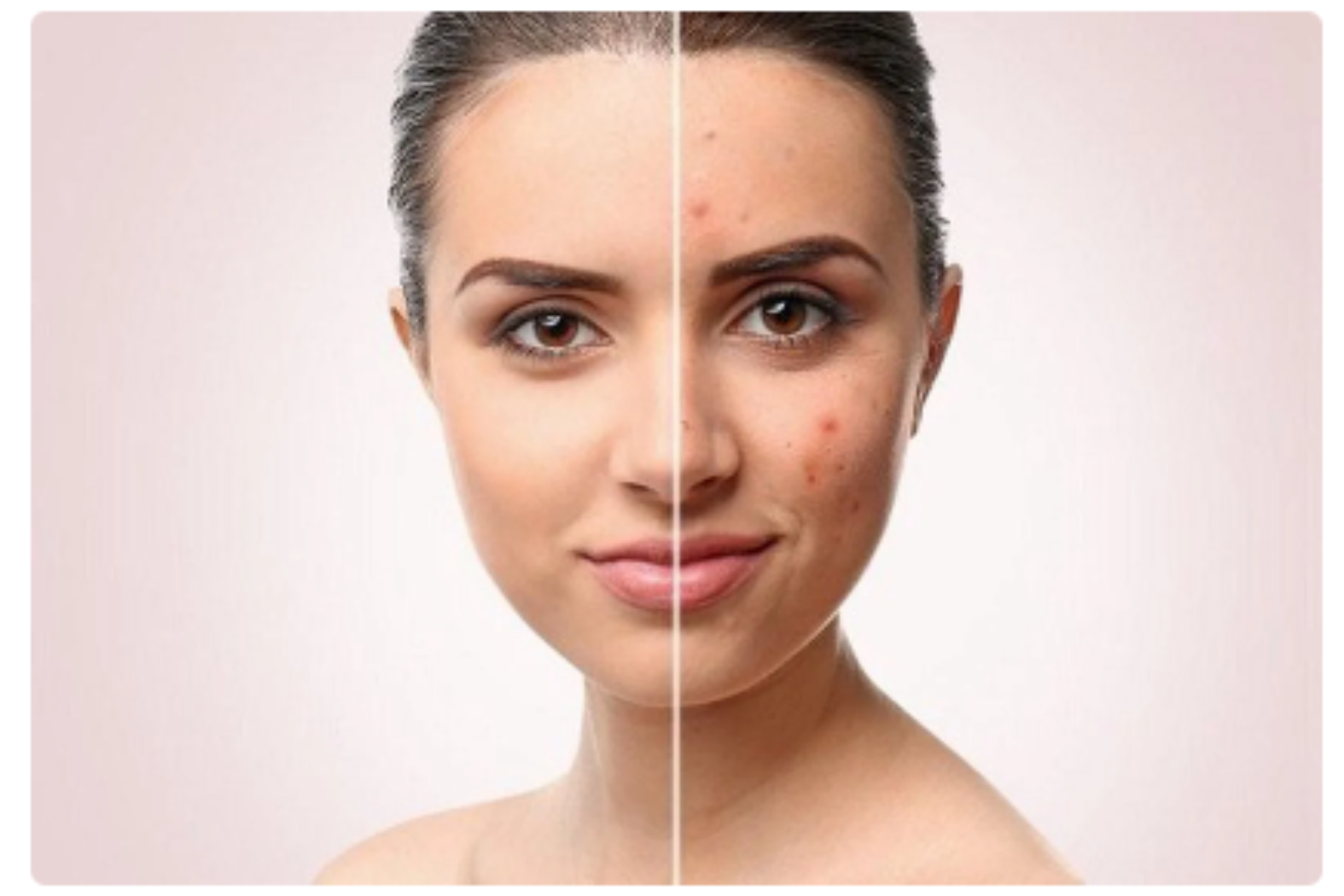 CÁCH TRỊ MỤN THÂM ĐÚNG CÁCH BẠN NÊN THAM KHẢO